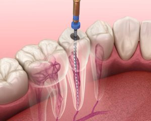 Endodonzia devitalizzazione apicectomia
